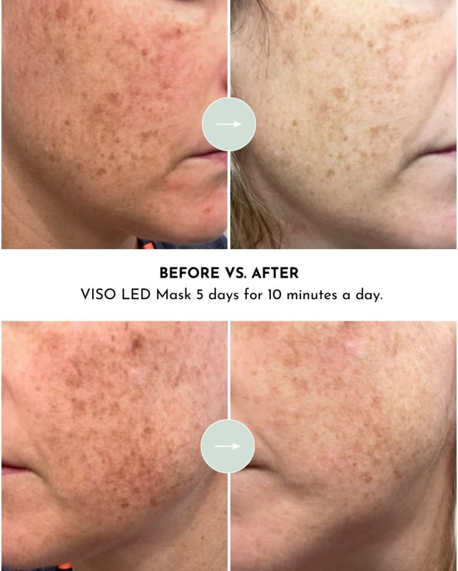 Lumara VISO - FDA Certified Red Light Therapy Mask